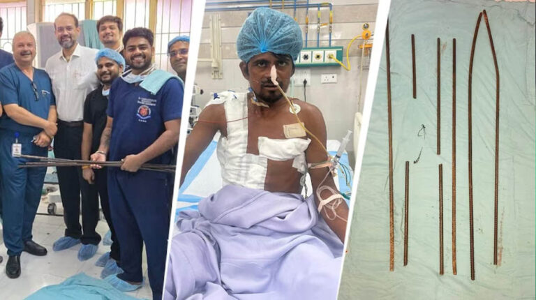 शरीर में आर-पार घुसे 4 लोहे के सरिये, KGMU के डॉक्टरों ने साढ़े आठ घंटे की सर्जरी से बचाई मजदूर की जान