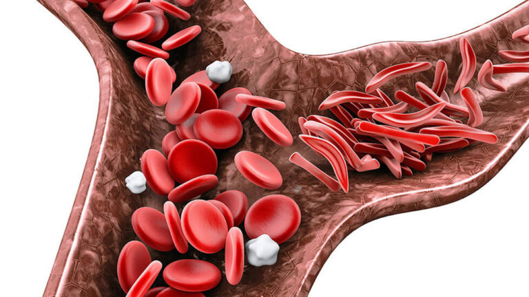 Sickle Cell Disease: देश के 59% मरीज ओडिशा और MP में मिले, 7.27 करोड़ लोगों की हुई जांच